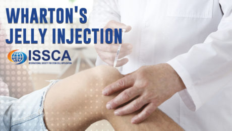 wharton jelly injection wharton jelly injection